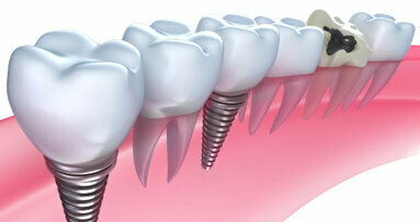 Dental implantology: Evolution or the road to ruin?