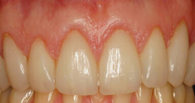 Two-stage esthetic crown lengthening