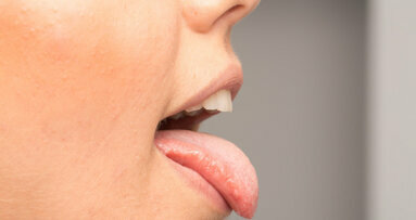La saliva humana ayuda a sanar las heridas