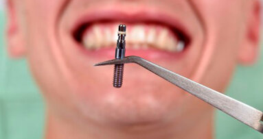Una ricerca rivela nei pazienti equivoci fondamentali in tema di impianti dentali