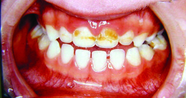 Early Childhood Caries: A Continuing Epidemic Oral Health Problem in the United Arab Emirates