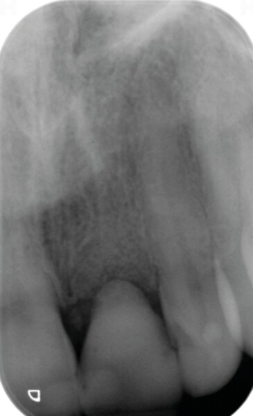 Fig. 8 : Radiographie montrant l’élément composite servant de pontique qui se prolonge dans l’alvéole d’extraction.