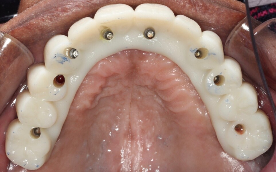 Fig. 22: Occlusal view of the complete maxillary try-in Flexcera Smile duplicate of the final prosthesis.