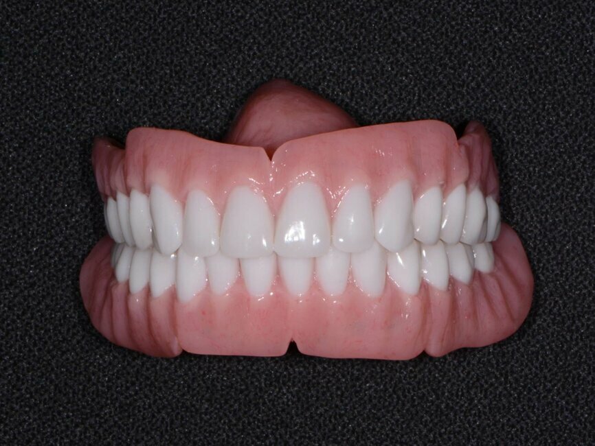Fig. 5: Immediate dentures.