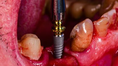 Silver nanoparticle-coated membrane may enhance dental implant treatment