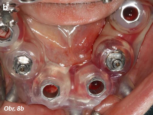 Zvětšený snímek in situ první šablony zhotovené pomocí CAD/CAM (s oporou o zub a sliznici) zachycuje dokonalé dosednutí na zubu 33 (a). Okluzální pohled na druhou šablonu (s oporou o implantát a sliznici) po zavedení implantátů v oblastech zubů 44 a 35 a extrakci zubů 42 a 33 (b).