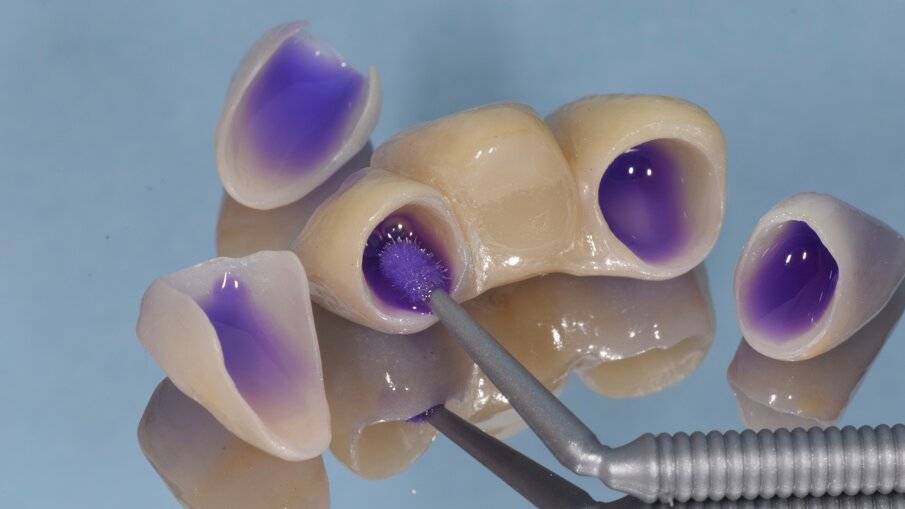 Fig. 7: Cleaning of the fixed dental prostheses with KATANA Cleaner after the try-in.