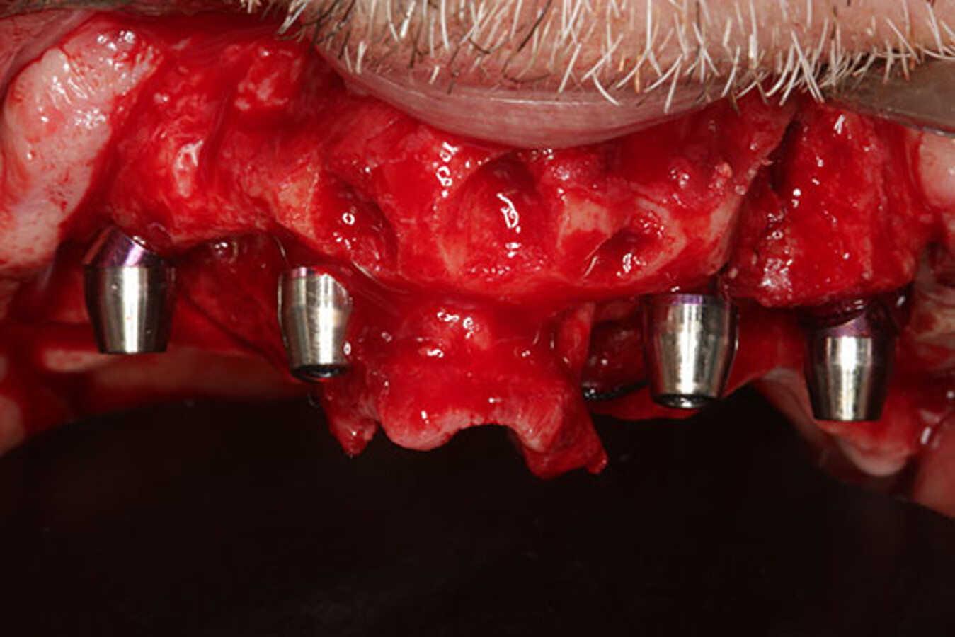 Fig. 14. ColocaciÃ³n de pilares transepiteliales rectos (implantes anteriores) y angulados de 30 grados en los implantes distales y sus tapones de protecciÃ³n. 