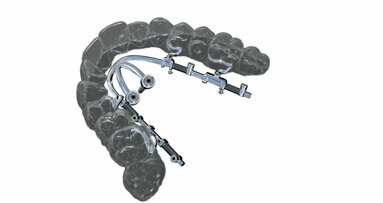 Mini-implant-borne sliders and expanders to overcome aligner limitations