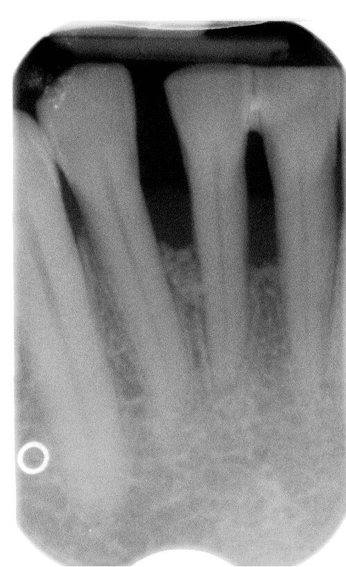 Fig. 6p - Radiografia a 6 mesi.