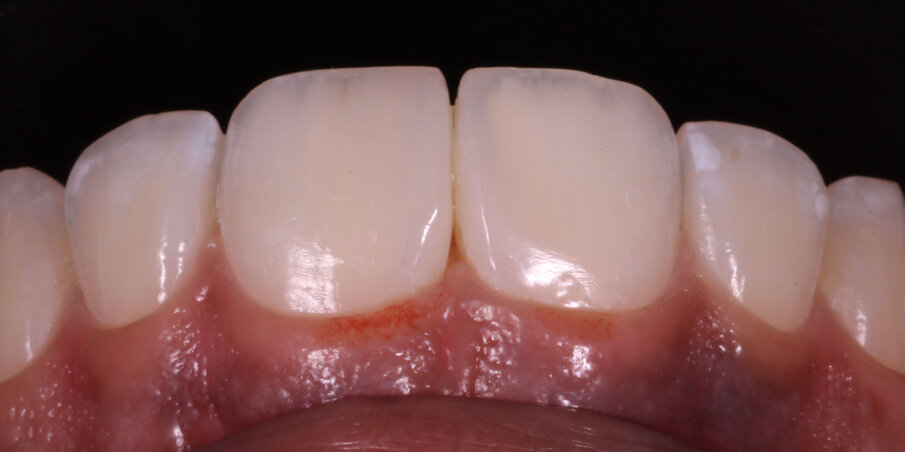 Fig 12. Post op after FInishing and Polishing