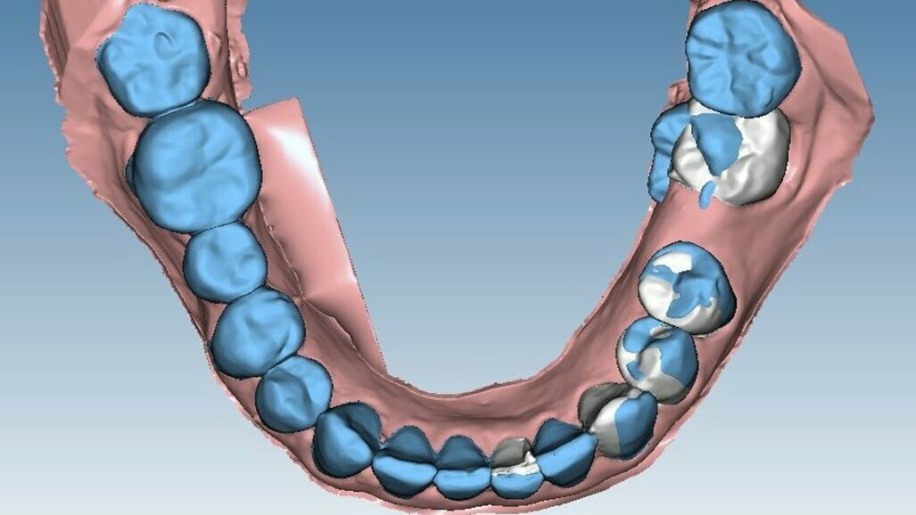 Progettazione ortodontica digitale di un caso di scissor bite