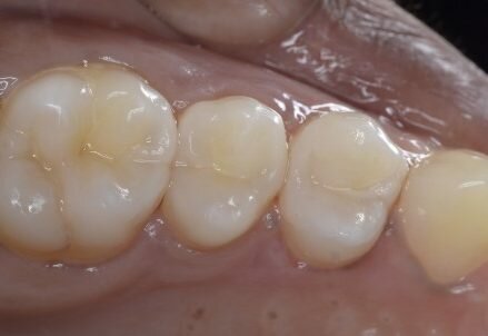 Achieving predictability in posterior restorations with modern matrix systems and bulkfill materials.