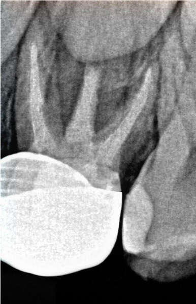 Fig. 6: Post-op radiograph. (Image: Dr Anne Heinz)