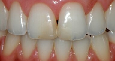 Restauraciones de dientes anteriores con traslucidez incisal