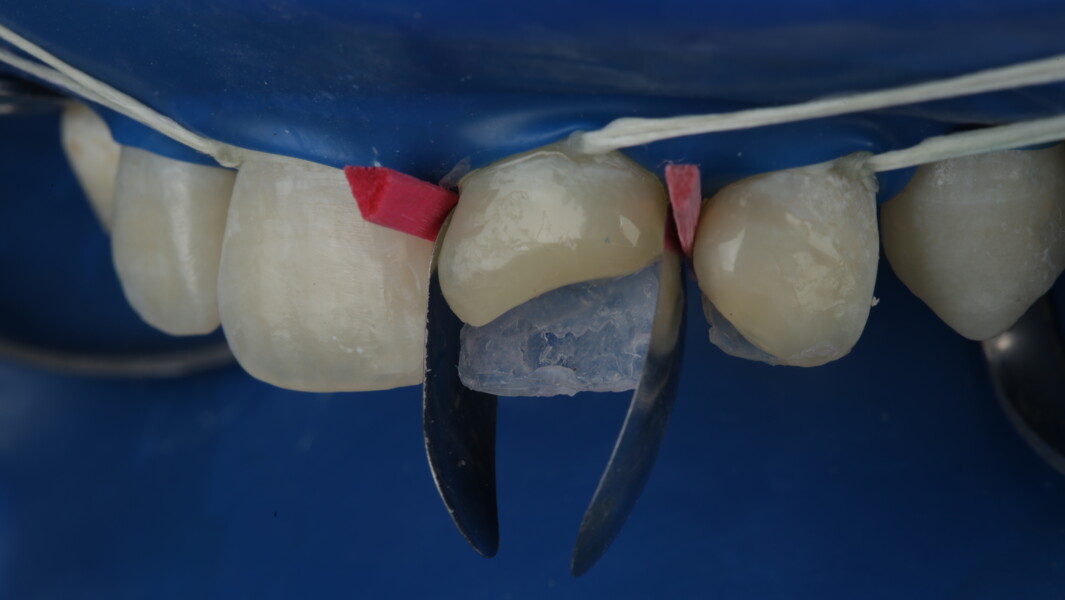Fig 19 and Fig 20: The sectional matrix for posterior teeth was used in a vertical direction and stabilized with wedge on both mesial and distal side.