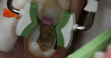 Garrison Dental Composi-Tight 3D Fusion System