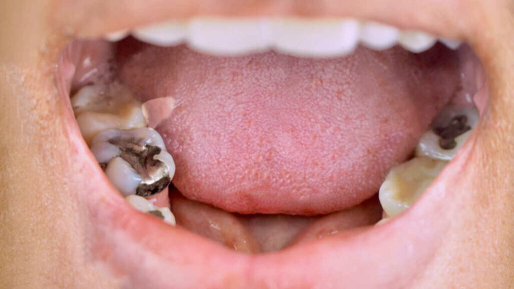 P-Irlannin British Dental Association: Vaiheittainen luopuminen hammasamalgaamista on mahdotonta