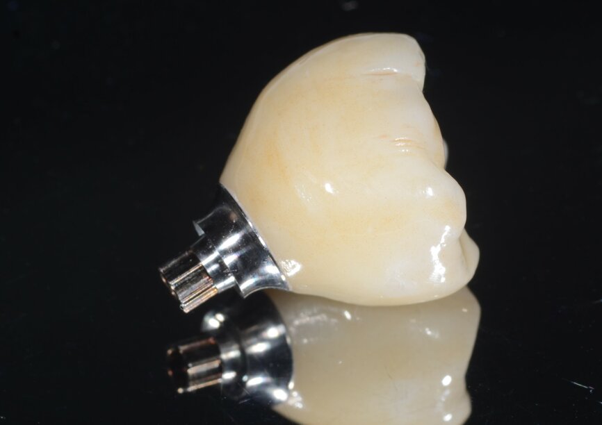 Fig. 16: Monolithic zirconia crown on wide base Variobase abutment ready for placement. 