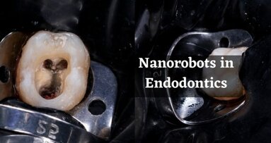 Nanorobots will prevent root canal treatment failures