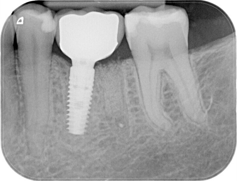 Fig. 18: Radiographic evaluation eight weeks after implant placement with final zirconia crown.