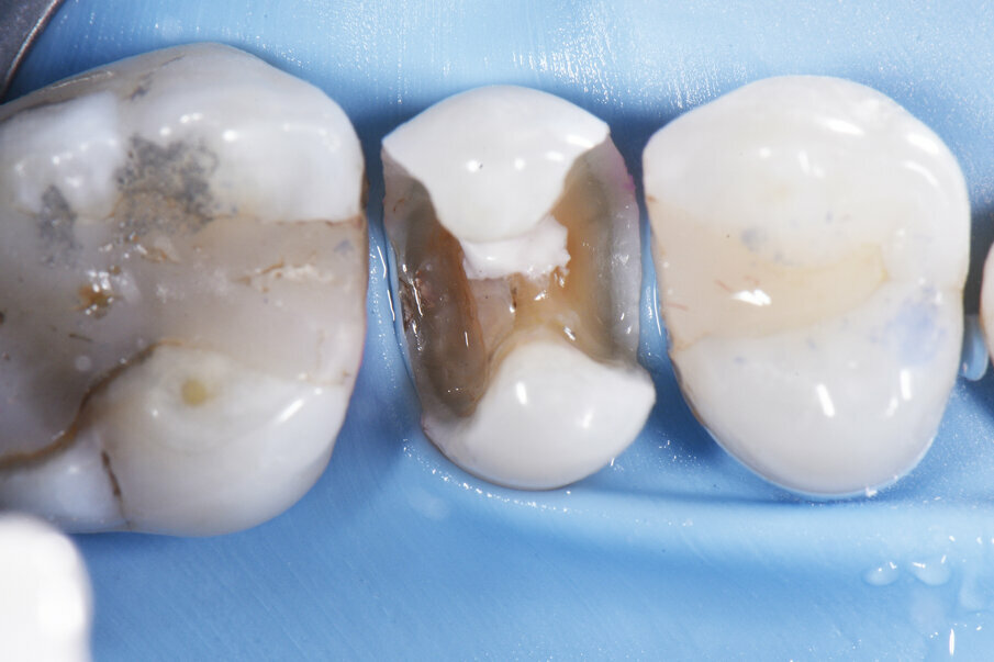 Before - Intraoperative situation showing extent of large MODL Class II restoration. Resin-modified calcium silicate liner placed against area of deeper dentin with near-carious pulp exposure. Wedgeguards will protect against accidental adjacent tooth grazing during preparation, and also double as the wedge for the Palodent® V3 sectional matrix assembly.