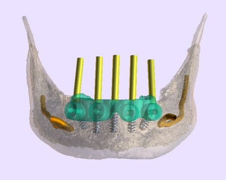 Fig. 7b: Reduced mandible, nerves and simulated implants with selective transparency.