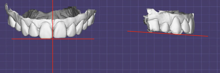 Fig. 1: Digital model imported into exocad dental software; the red lines illustrate the dental midline and occlusal plane estimated from tooth position without reference points.