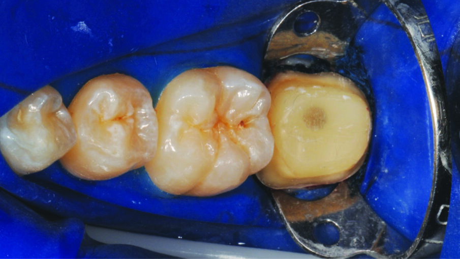 Fig. 6: Tooth preparation after rubber dam placement for isolation.