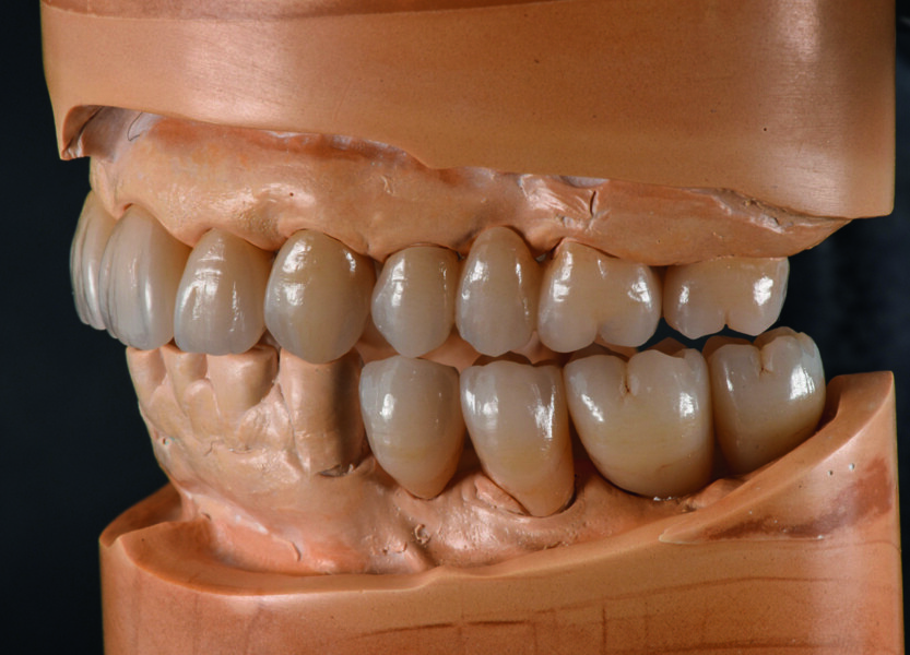 Fig. 9b : Surfaces occlusales et pente canine parfaites pendant le mouvement mandibulaire. 