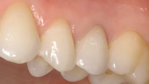 Dental News - Computer-aided crown design – Fabrication of CAD/CAM ...