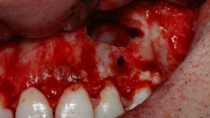 Gli emocomponenti in chirurgia orale: esperienza della scuola di Torino