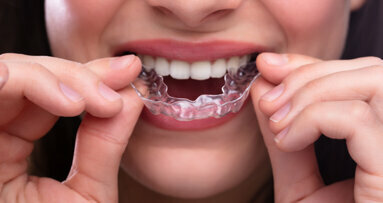 The necessity of multiple aligner attachments—a reality check