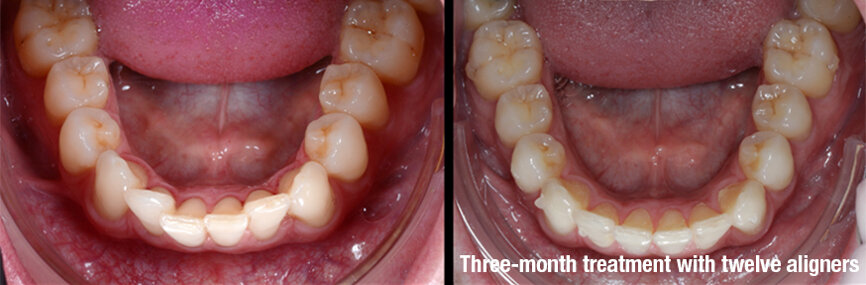 Fig. 2: Before (left) and after (right). The case was solved over three months with 12 clear aligners (Smilers) and photobiomodulation therapy (with the ATP38), applied every week for six minutes every time aligners were changed.