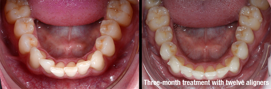 Fig. 2:  Before (left) and after (right). The case was solved over three months with 12 clear aligners (Smilers) and photobiomodulation
therapy (with the ATP38), applied every week for six minutes every time aligners were changed.