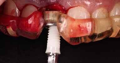 How to attract new patients by offering ceramic dental implants