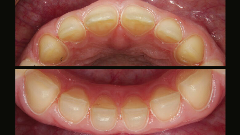 Figure 8: Completed preparation of the upper and lower anterior teeth (partial preparation)