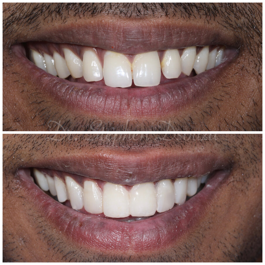 Fig. 11 Preoperative and postoperative frontal smile comparison