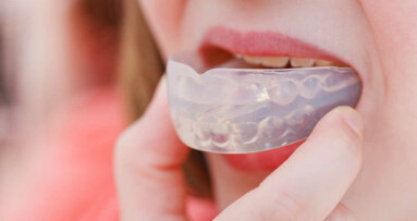 Tutkijoiden kehittämä hammaskoje auttaa havaitsemaan kaviteettien varhaisia merkkejä