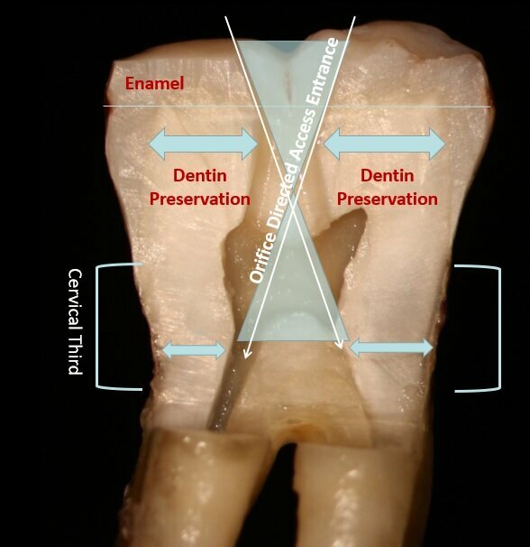 Fig. 3: An orifice-directed access conserves more tooth structure as it follows the direction of the canal, resulting in a smaller access opening and preservation of critical tooth. 
