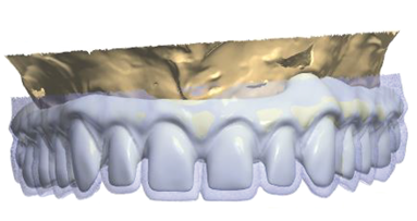 The use of CBCT and CAD/CAM techniques in complex implant-supported rehabilitation of maxilla—Part I