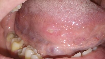 Ulcere traumatiche orali trattate con terapia fotodinamica