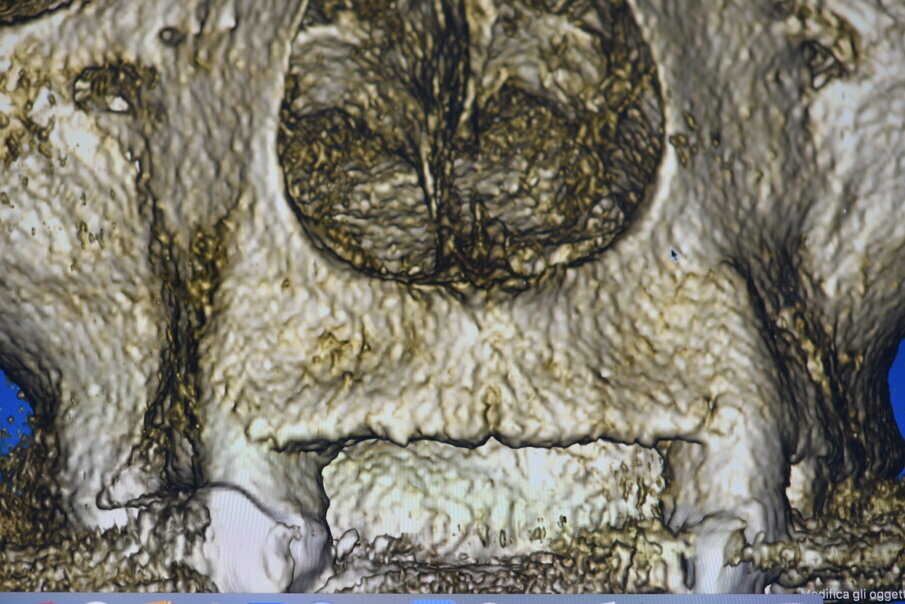 Fig. 8_Impatto visivo della CBCT nella porzione vestibolare che evidenzia la marcata lacuna ossea che impatta sull’estetica del II° sestante.