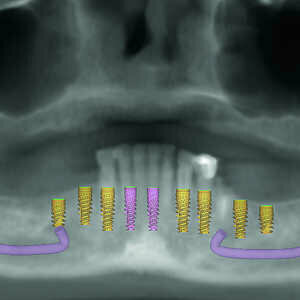 Fig-4-Présentation-du-traitement-de-l’arcade-mandibulaire-300x300-