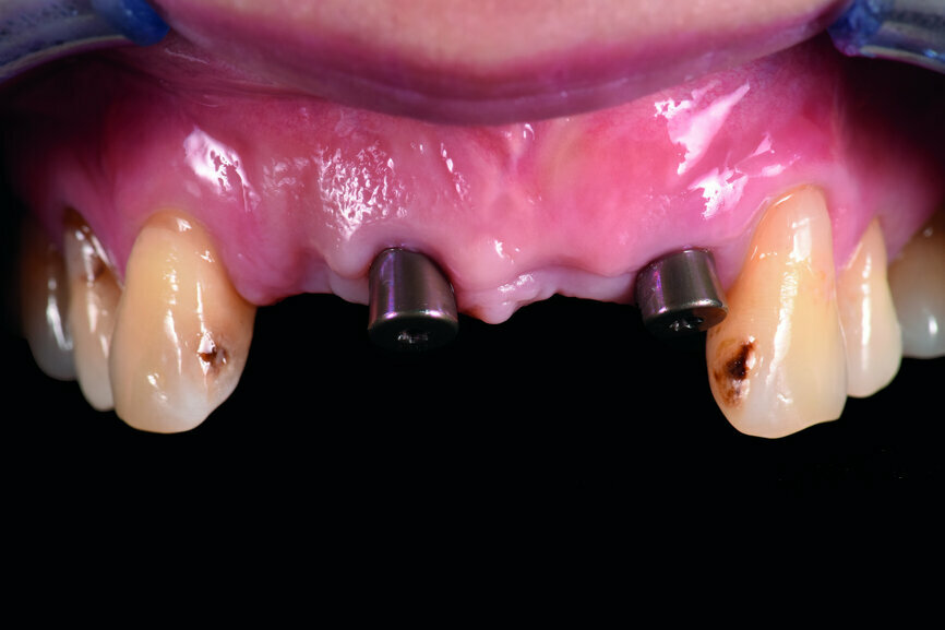 Fig. 7: Frontal view of the anterior teeth three months post-op.