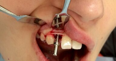 Zespołowe leczenie ortodontyczno-chirurgiczno-protetyczne pacjenta z hipodoncją