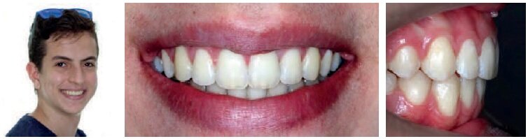 12 months of retention – Stable results – Dental and facial esthetics – Stability