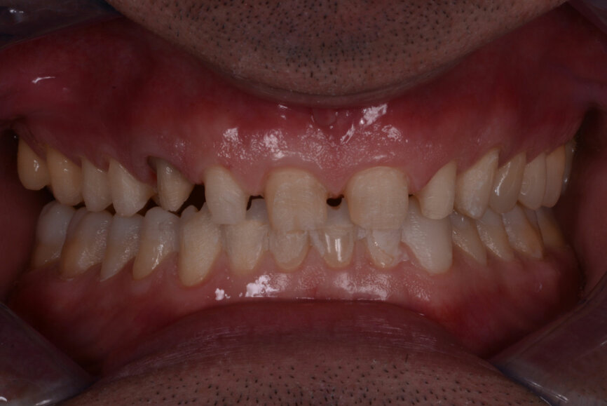 Fig. 8: No preparation of the posterior teeth and minimal preparation of the mandibular anterior teeth. Teeth #11–13 and 21–23 had already been prepared.