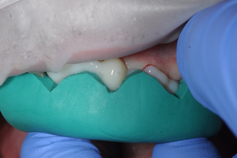 Fig. 6 Temporary veneers made from resin-based temporisation material (Protemp; 3M).