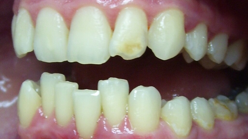 Réadaptation esthétique de dents antérieures hypoplasiques en  utilisant le Laser LiteTouch Er:YAG. Un rapport de cas.